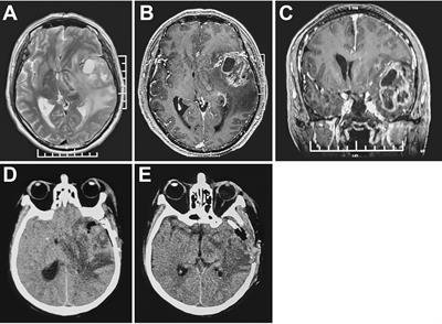 Early Unplanned Reoperation After Glioma Craniotomy: Incidence, Predictor and Process Improvement